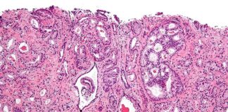Identificados los mecanismos moleculares que regulan la hipoxia del cáncer de próstata Micrografía que muestra adenocarcinoma acinar prostático (la forma más común de cáncer de próstata)