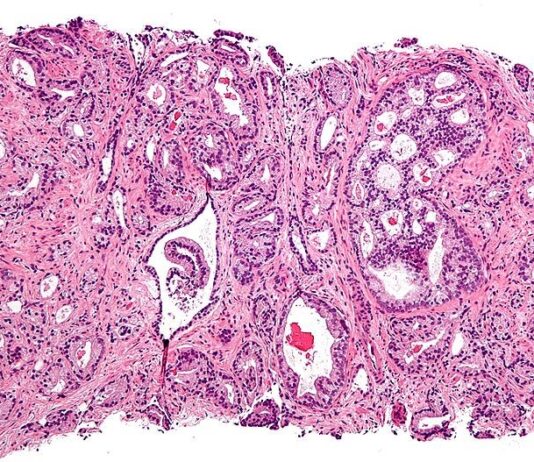 Identificados los mecanismos moleculares que regulan la hipoxia del cáncer de próstata Micrografía que muestra adenocarcinoma acinar prostático (la forma más común de cáncer de próstata)