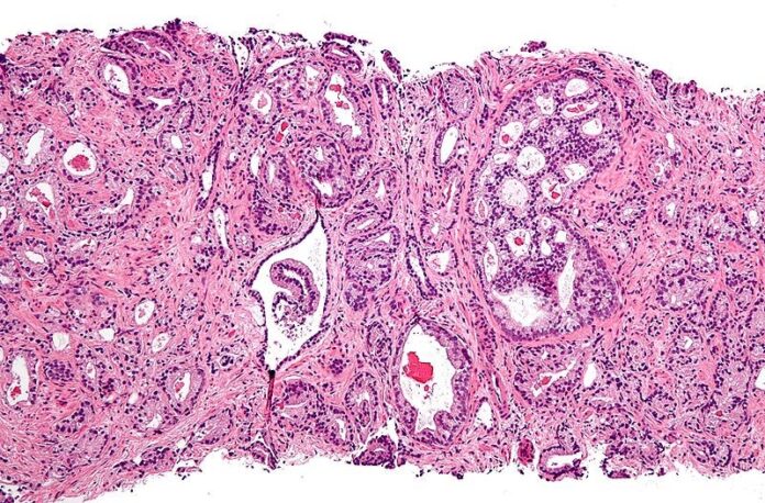 Micrografía que muestra adenocarcinoma acinar prostático (la forma más común de cáncer de próstata)