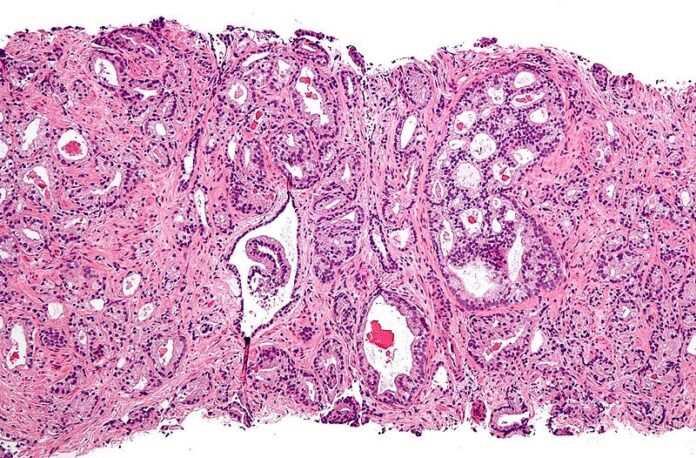 Micrografía que muestra adenocarcinoma acinar prostático (la forma más común de cáncer de próstata) Micrografía que muestra adenocarcinoma acinar prostático (la forma más común de cáncer de próstata)