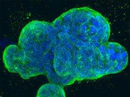 Vacuna contra el cáncer de mama genera inmunidad antitumoral de forma segura en un estudio preliminar Cultivo tridimensional de células de cáncer de mama humano