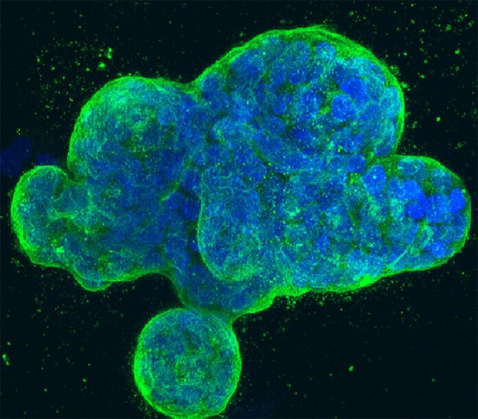 Cultivo tridimensional de células de cáncer de mama humano Cultivo tridimensional de células de cáncer de mama humano