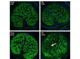 Glaucoma: El estrés repetitivo acelera el envejecimiento del ojo Cuando el equipo dirigido por UCI investigó la cabeza del nervio óptico de los ojos tratados con una leve elevación de la presión, notaron que en la cabeza del nervio óptico joven no había signos de pérdida de axones. Sin embargo, en los nervios ópticos de animales viejos se observó una pérdida sectorial significativa de axones similar al fenotipo comúnmente observado en pacientes con glaucoma