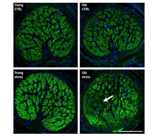 Glaucoma: El estrés repetitivo acelera el envejecimiento del ojo Cuando el equipo dirigido por UCI investigó la cabeza del nervio óptico de los ojos tratados con una leve elevación de la presión, notaron que en la cabeza del nervio óptico joven no había signos de pérdida de axones. Sin embargo, en los nervios ópticos de animales viejos se observó una pérdida sectorial significativa de axones similar al fenotipo comúnmente observado en pacientes con glaucoma
