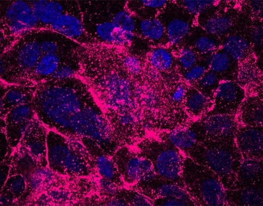 Células tolerantes al estrés impulsan la iniciación del cáncer de páncreas Cáncer de páncreas: Las células iniciadoras de tumores (azul) producen una matriz extracelular que contiene fibronectina (rosa), lo que les confiere una mayor tolerancia al estrés, resistencia a los medicamentos y propiedades iniciadoras de tumores