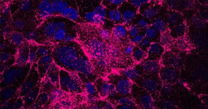 Cáncer de páncreas: Las células iniciadoras de tumores (azul) producen una matriz extracelular que contiene fibronectina (rosa), lo que les confiere una mayor tolerancia al estrés, resistencia a los medicamentos y propiedades iniciadoras de tumores Cáncer de páncreas: Las células iniciadoras de tumores (azul) producen una matriz extracelular que contiene fibronectina (rosa), lo que les confiere una mayor tolerancia al estrés, resistencia a los medicamentos y propiedades iniciadoras de tumores