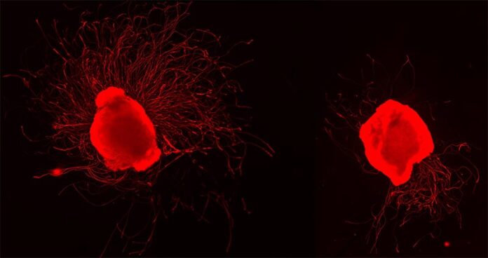 Polineuropatía desmielinizante inflamatoria crónica: Crecimiento de células nerviosas con y sin la administración de propionato Polineuropatía desmielinizante inflamatoria crónica: Crecimiento de células nerviosas con y sin la administración de propionato
