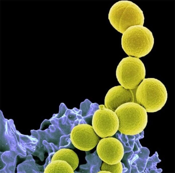 Bacteria Staphylococcus aureus resistente a la meticilina (amarilla) siendo ingerida por neutrófilos Bacteria Staphylococcus aureus resistente a la meticilina (amarilla) siendo ingerida por neutrófilos