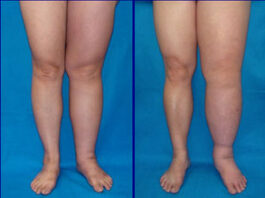 La inhibición de una proteína revierte el linfedema, según un estudio modelo in vitro en 3D Linfedema en la pierna izquierda, en cuatro estadios distintos