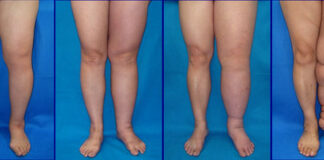 La inhibición de una proteína revierte el linfedema, según un estudio modelo in vitro en 3D Linfedema en la pierna izquierda, en cuatro estadios distintos