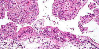 Cáncer de ovario: la inteligencia artificial predice las respuestas a la terapia Cáncer de ovario