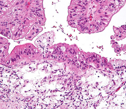 Cáncer de ovario: la inteligencia artificial predice las respuestas a la terapia Cáncer de ovario